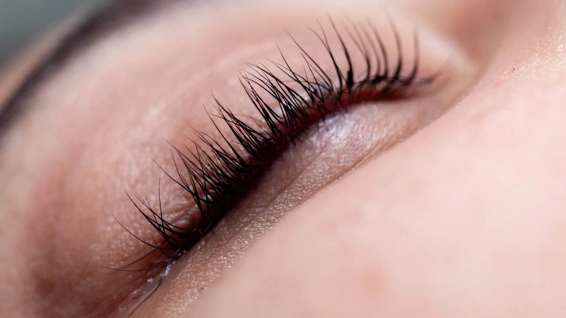 Face and upper lip laser hair removal at Nova Laser & Beauty Clinic, Yeroskipou - Candela Alexandrite session