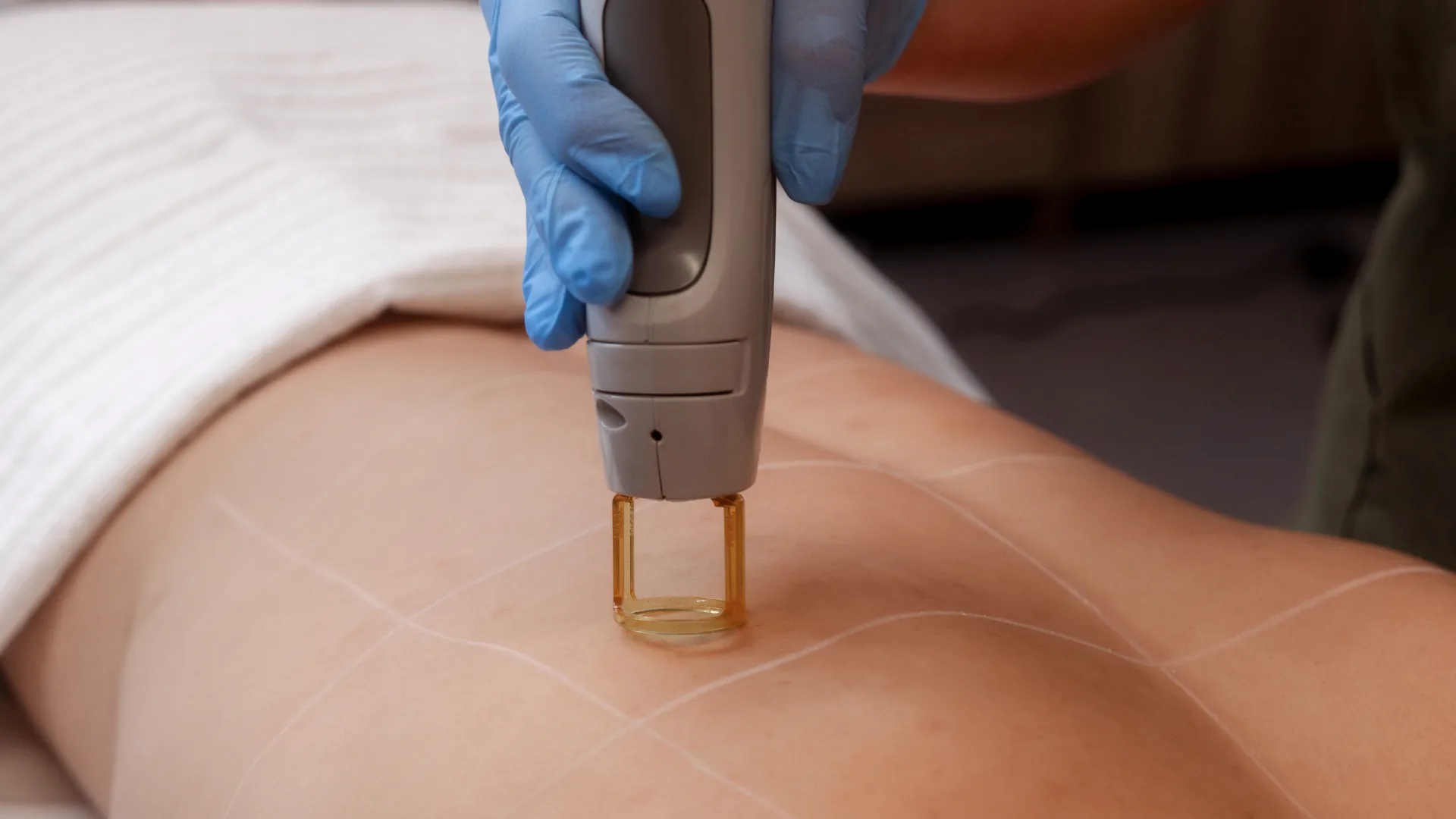 Women's leg laser hair removal at Nova Laser & Beauty Clinic in Yeroskipou